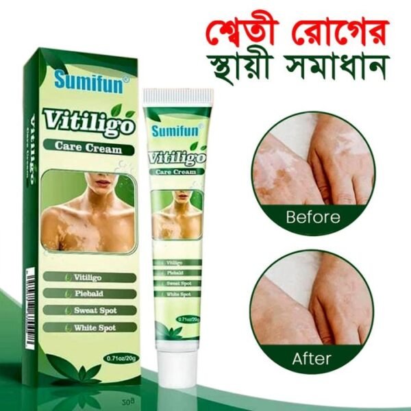 Sumifun Vitiligo Cream Reduces White Spots and Improves Skin Pigmentation - 20 gm